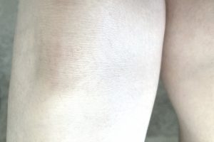 脱毛施術後の右足